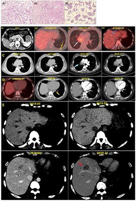 Case Report: Efficacy of Pyrotinib in ERBB2 Amplification Pulmonary Adenoid Cystic Carcinoma
